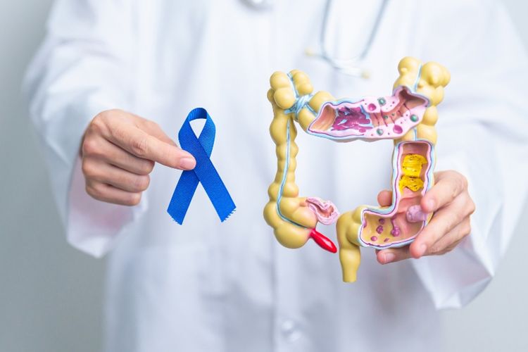 Pusat Onkologi Melengkapi Perawatan Kanker Kolorektal Tingkat Lanjut di Rumah Sakit Mayapada