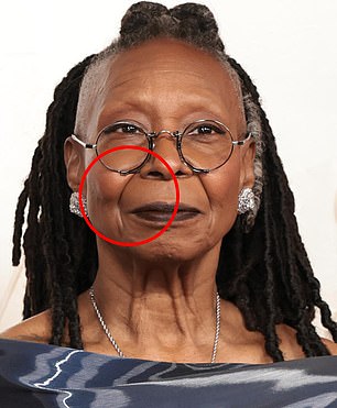 Bizarre 'Ozempic mouth' is the latest weight-loss drug side effect