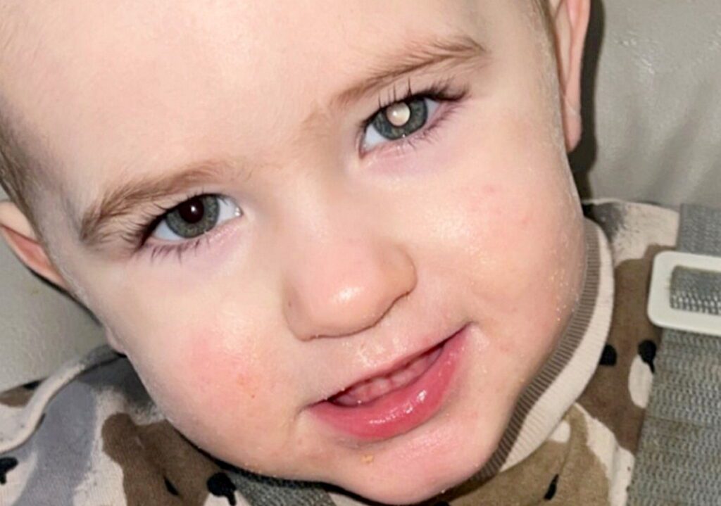Tot diagnosed with cancer after parents spotted white glow in his eye
