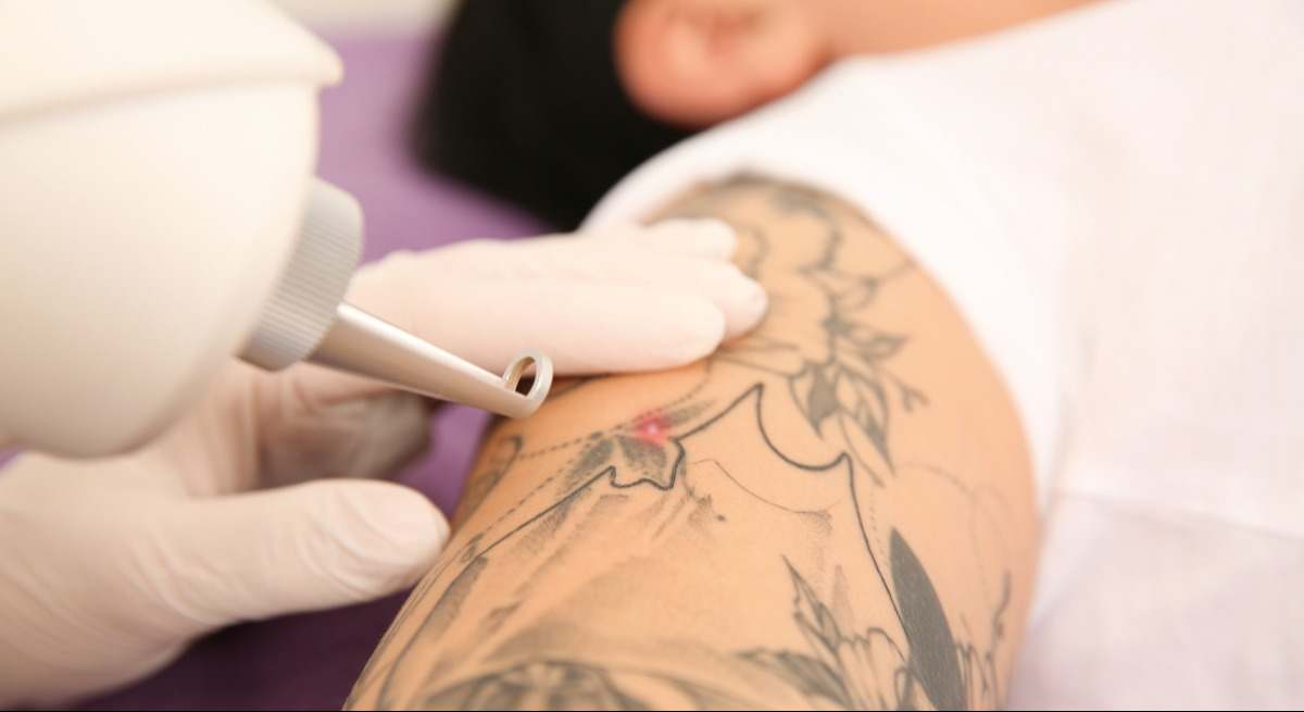 Is Your Tattoo Too Old Factors Affecting Removal Riyadh