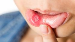 Hanya Sariawan? Ini Tanda Tubuh Kekurangan Vitamin C