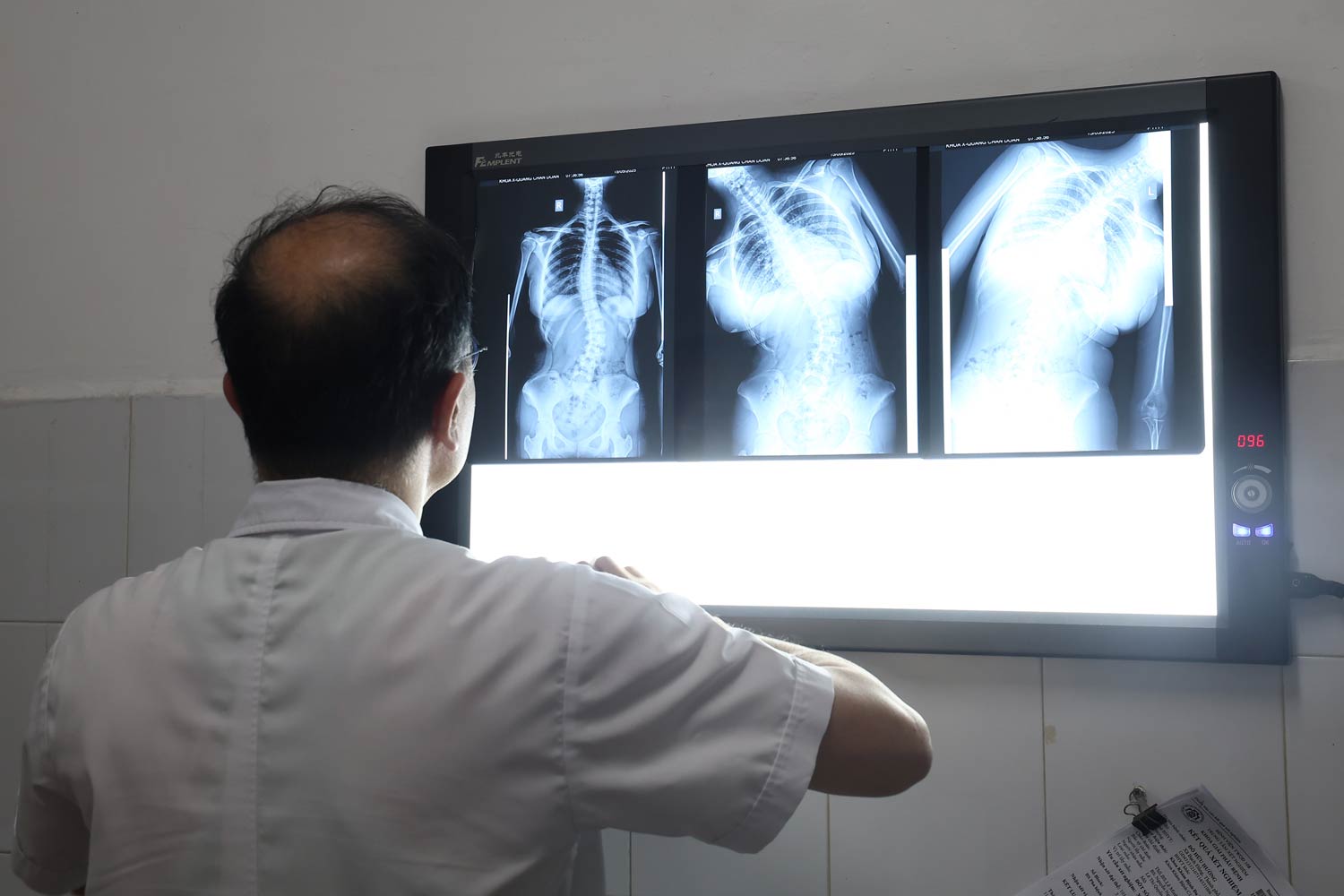 Vẹo cột sống ở trẻ có thể gây ra nhiều ảnh hưởng không ngờ tới sức khỏe