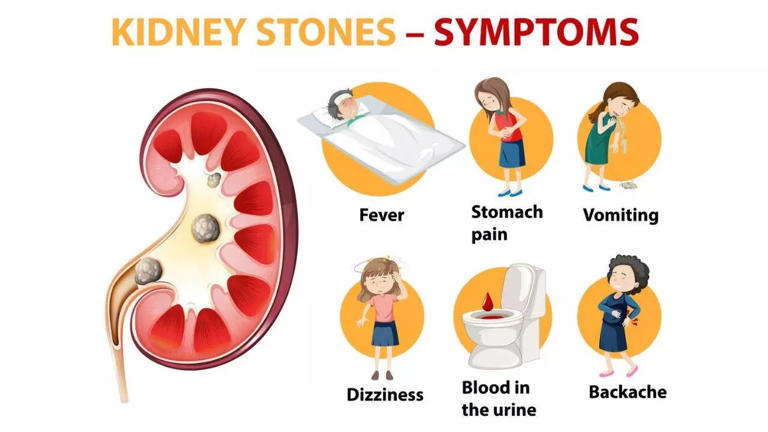 6 silent signs of kidney stones: Do men and women experience different symptoms?