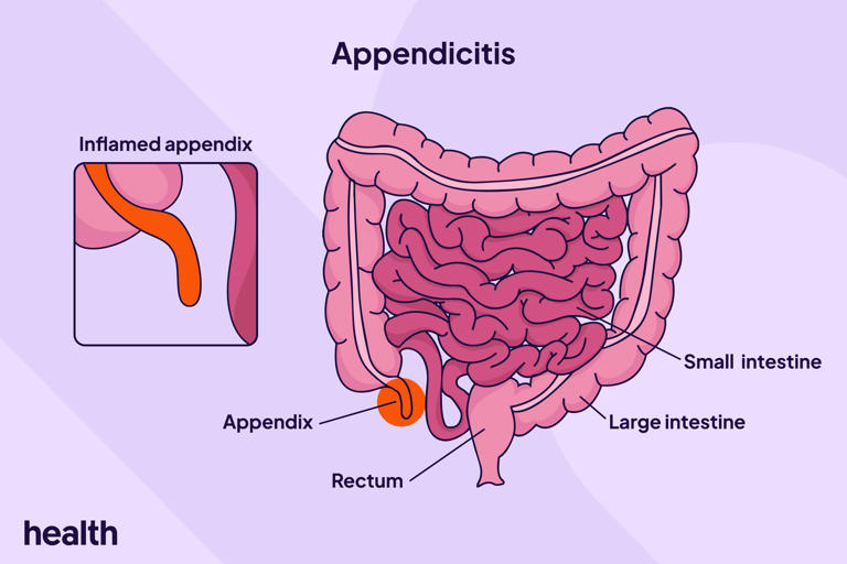 4 stages of appendicitis symptoms and when to get help