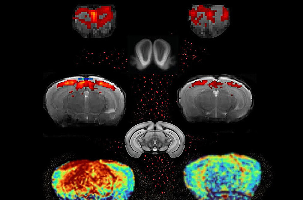 Simple brain scan offers hope for detecting Parkinson's disease much ...