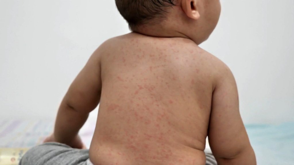 Measles cases show signs of exponential growth in western Canada, say ...
