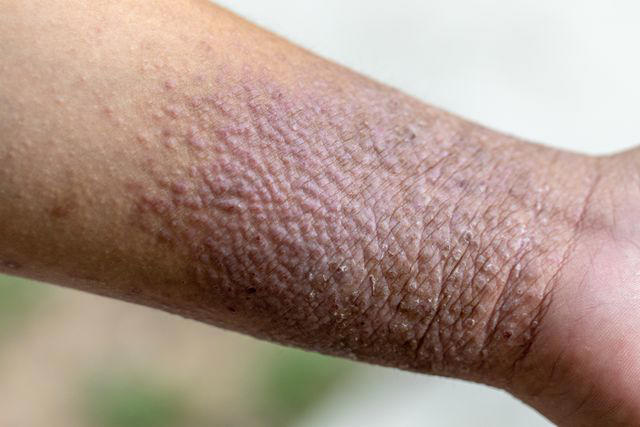What Does Atopic Dermatitis Look Like on Darker Skin?