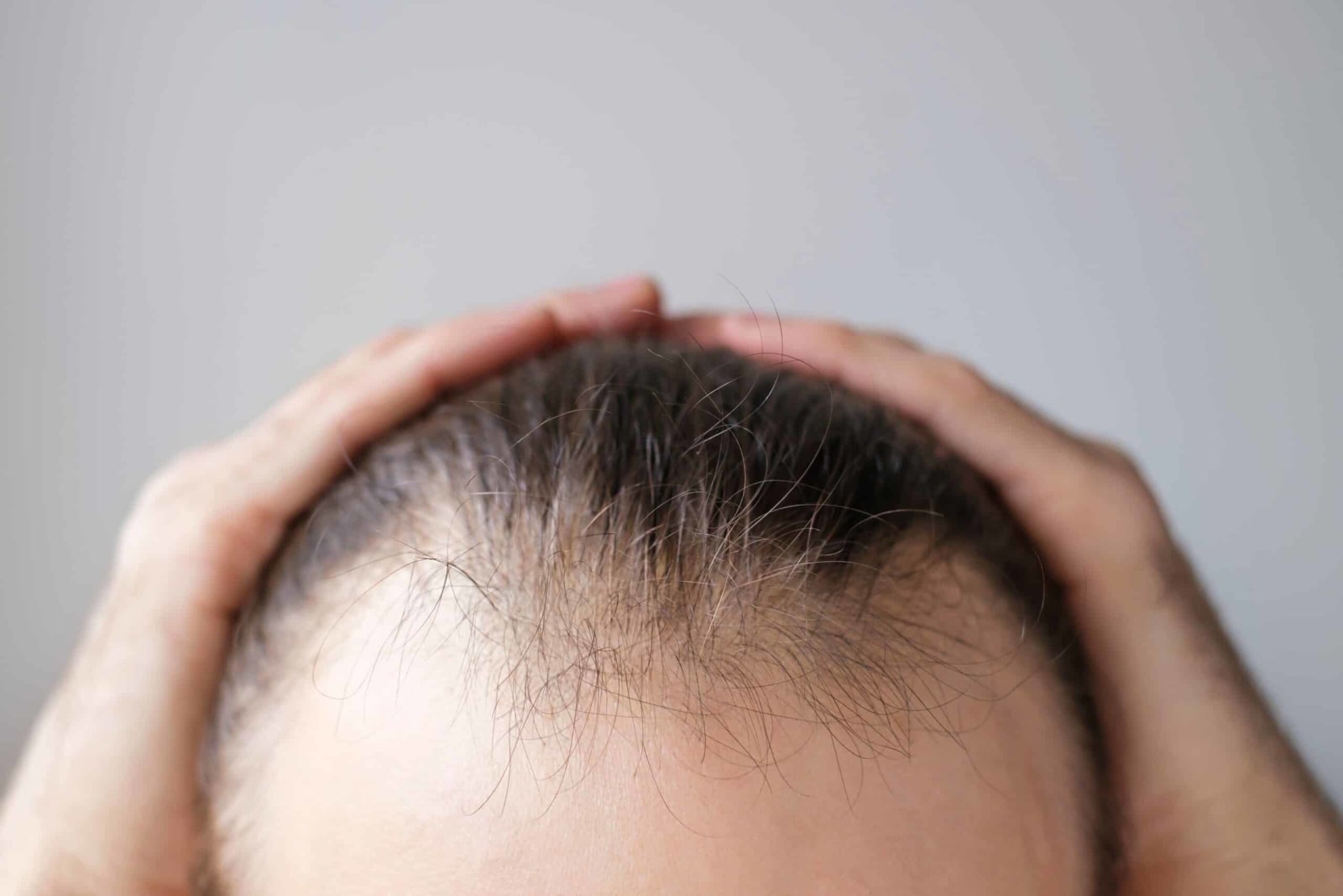 What If Baldness Isn’t Permanent After All? Scientists Found What Actually Stops Hair from Growing—And How to Restart It