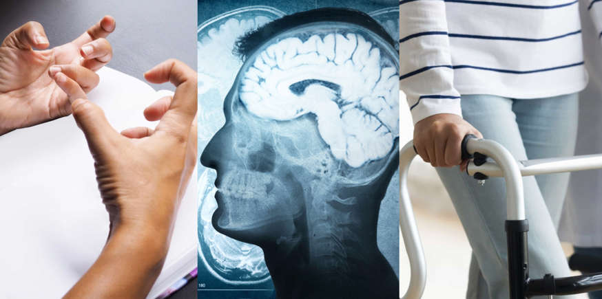 MH : une pathologie neurologique rare