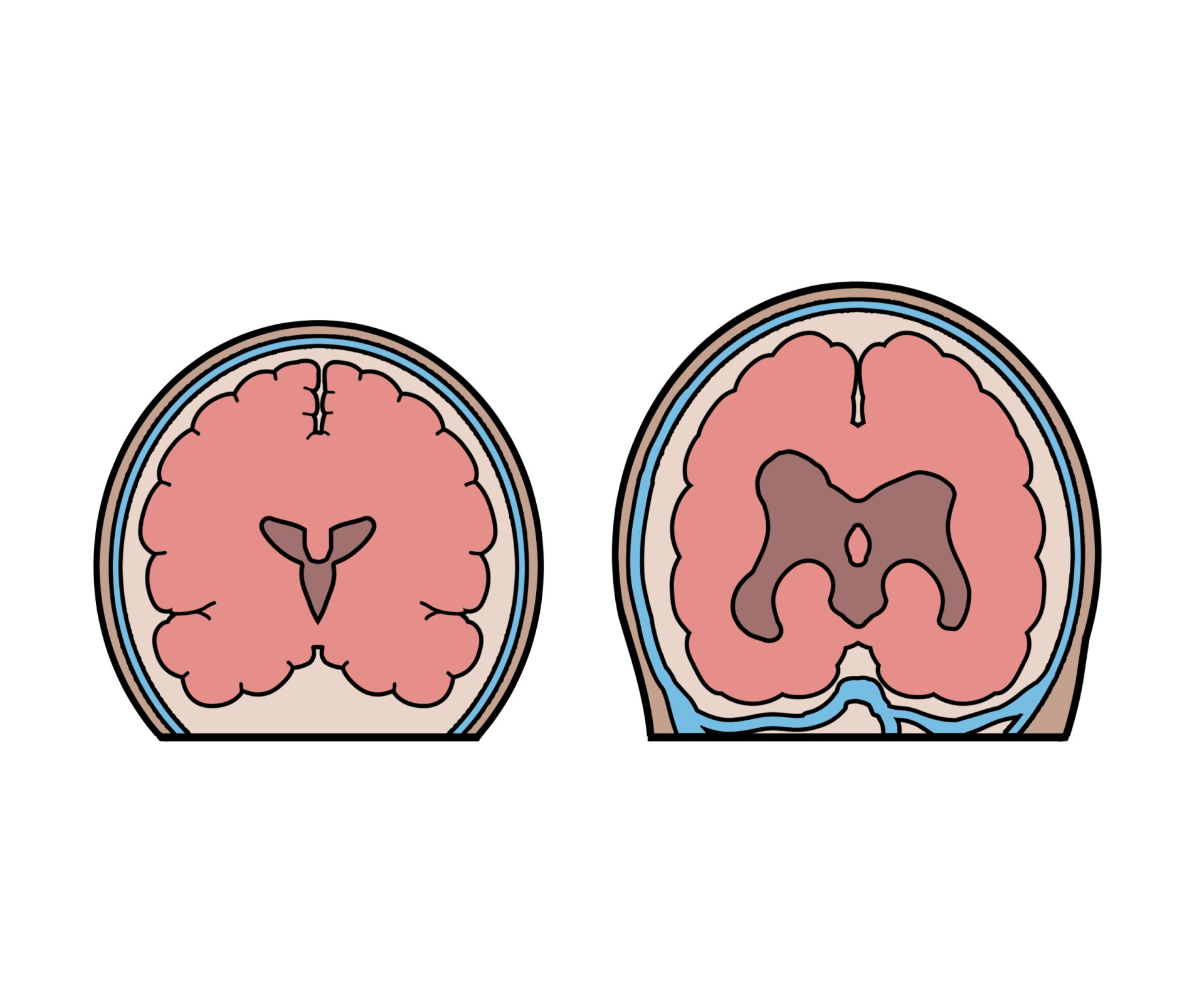 What is the brain disorder affecting Billy Joel?