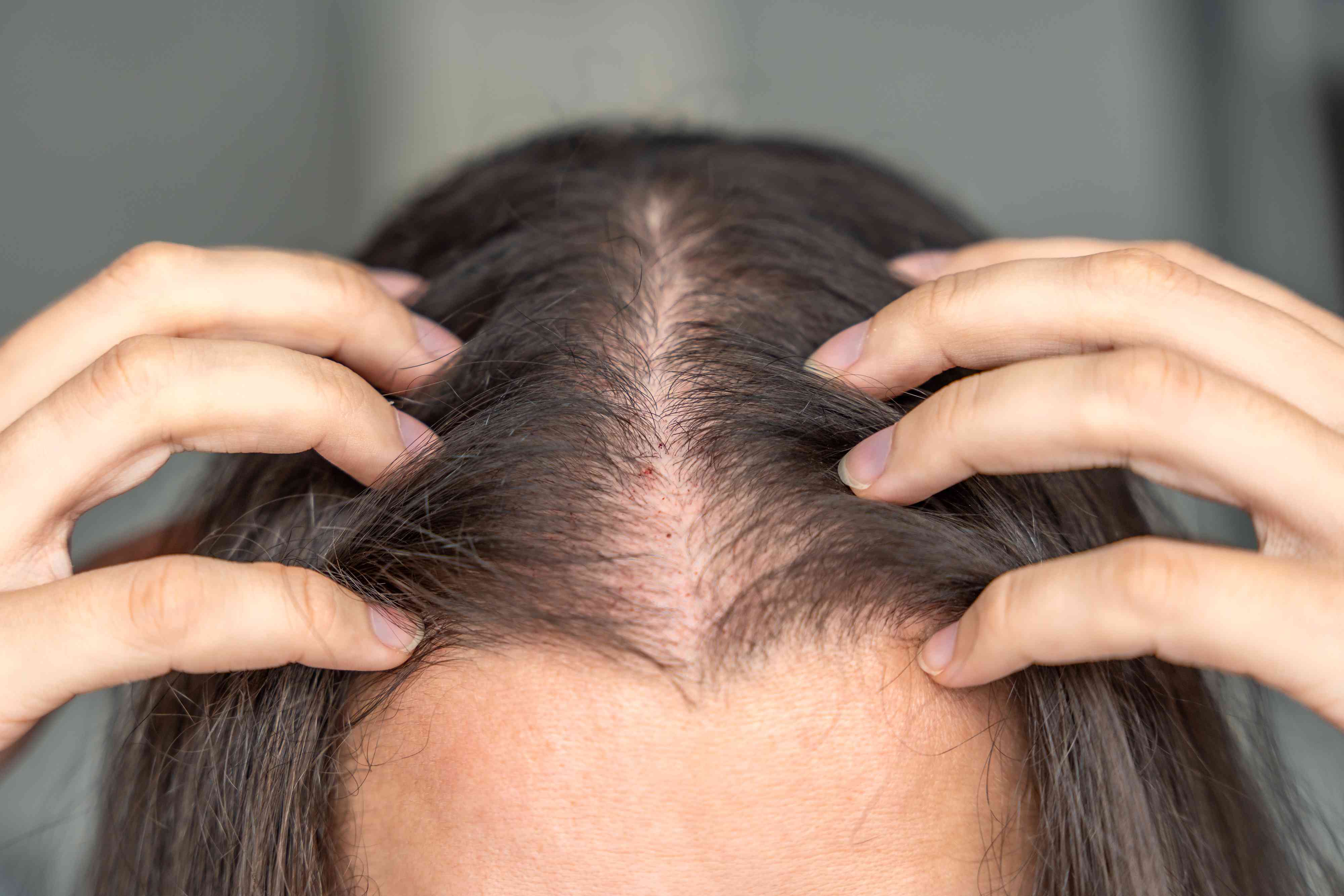 what-causes-hair-loss-after-surgery-and-how-to-cope-with-it