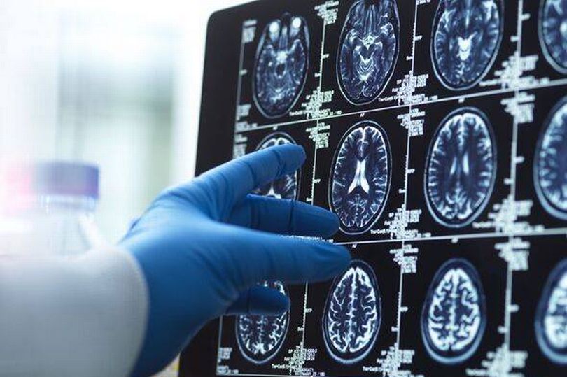 WHAT IS MULTIPLE SCLEROSIS AN EXPERT EXPLAINS visual data 3