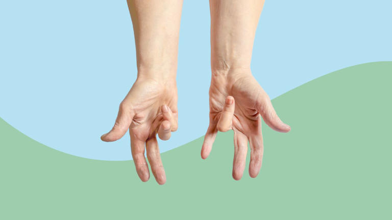 5 Hand Exercises to Try for Dupuytren's Contracture