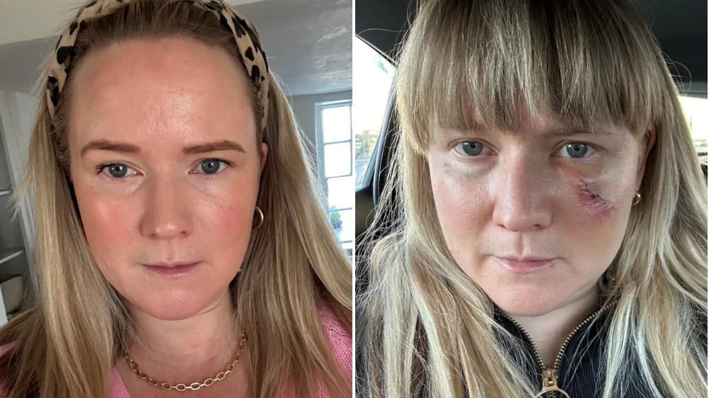 I Ignored The Signs Of Skin Cancer For Years Please Don T Make My Mistake