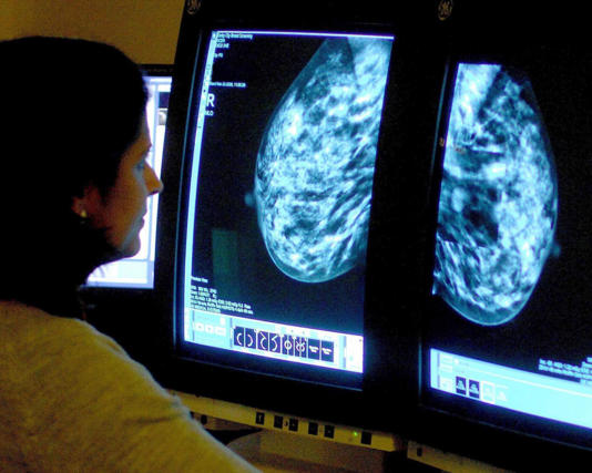 Regular mammograms can be less effective at spotting cancer in the 10% of women with very dense breasts, as the tissue can hide tumours on X-rays. Photograph: Rui Vieira/PA