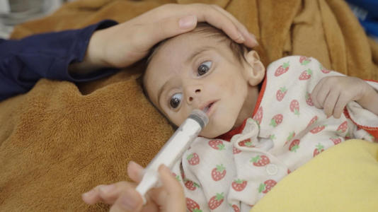 Baby Aya at Rantisi hospital in northern Gaza is dangerously thin