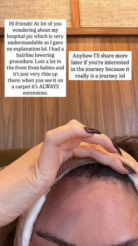 Chrissy Teigen Reveals She Underwent a ‘Hairline Lowering Procedure