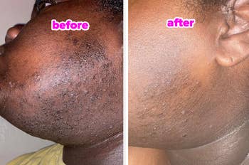 the reviewer before and after using the toner pads to clean up ingrown hair bumps