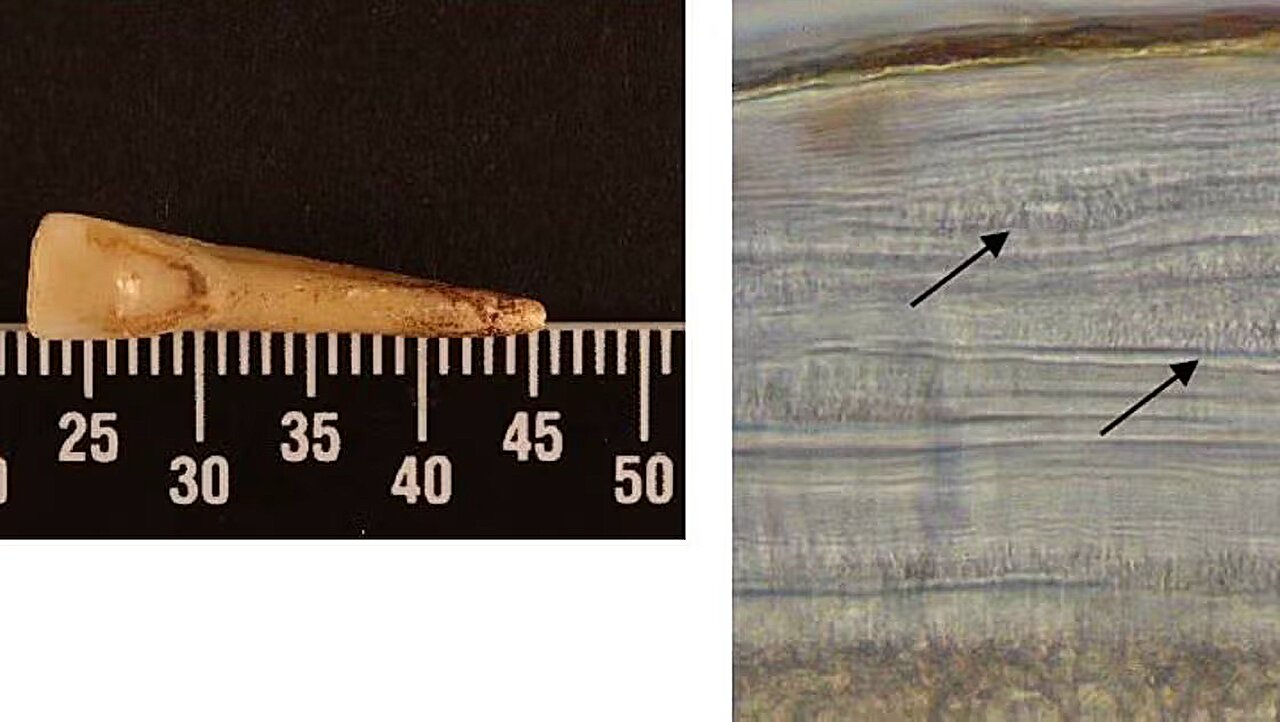 Analysis of tooth rings uncovers smoking's enduring impact, offering ...