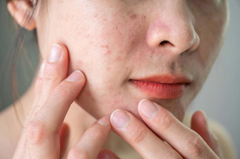 Skin tends to improve, with fewer breakouts and less inflammation, leading to a clearer complexion. (Photo: Getty Images)