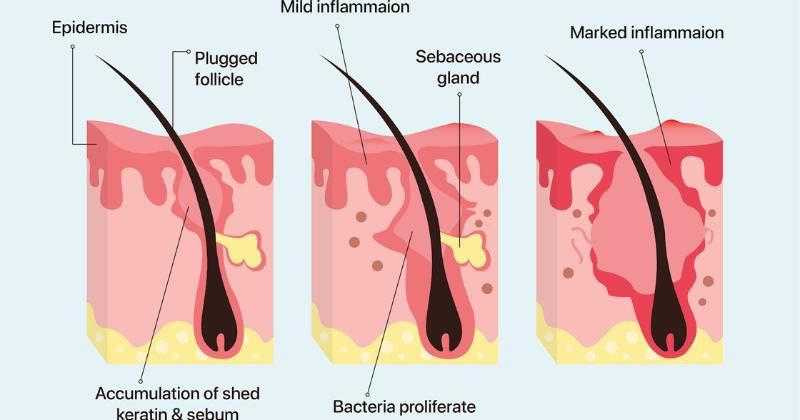 Cara Mengatasi Purging Retinol Tanpa Khawatir