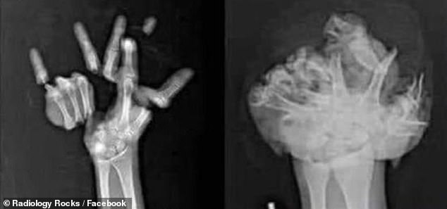 Disturbing X-rays reveal the horrors of lighting off fireworks on the ...