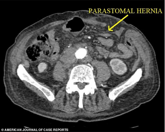 Colon cancer patient's intestines 'spontaneously' explode out of his ...