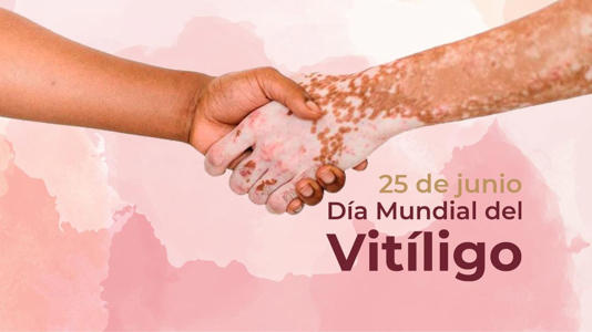 Día Mundial del Vitiligo: ¿por qué se conmemora el 25 de junio?