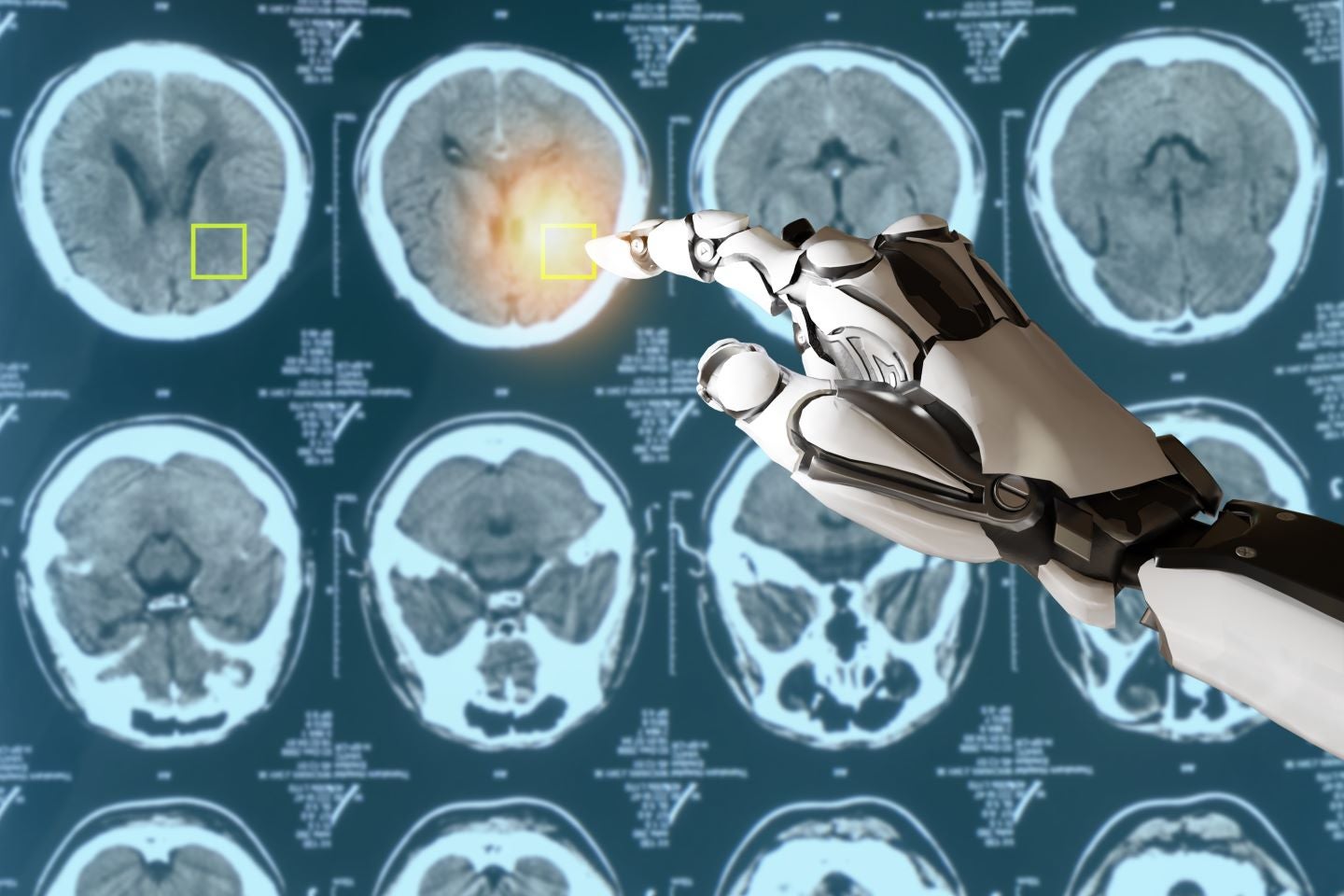 RadNet bolsters clinical AI capabilities with Gleamer acquisition