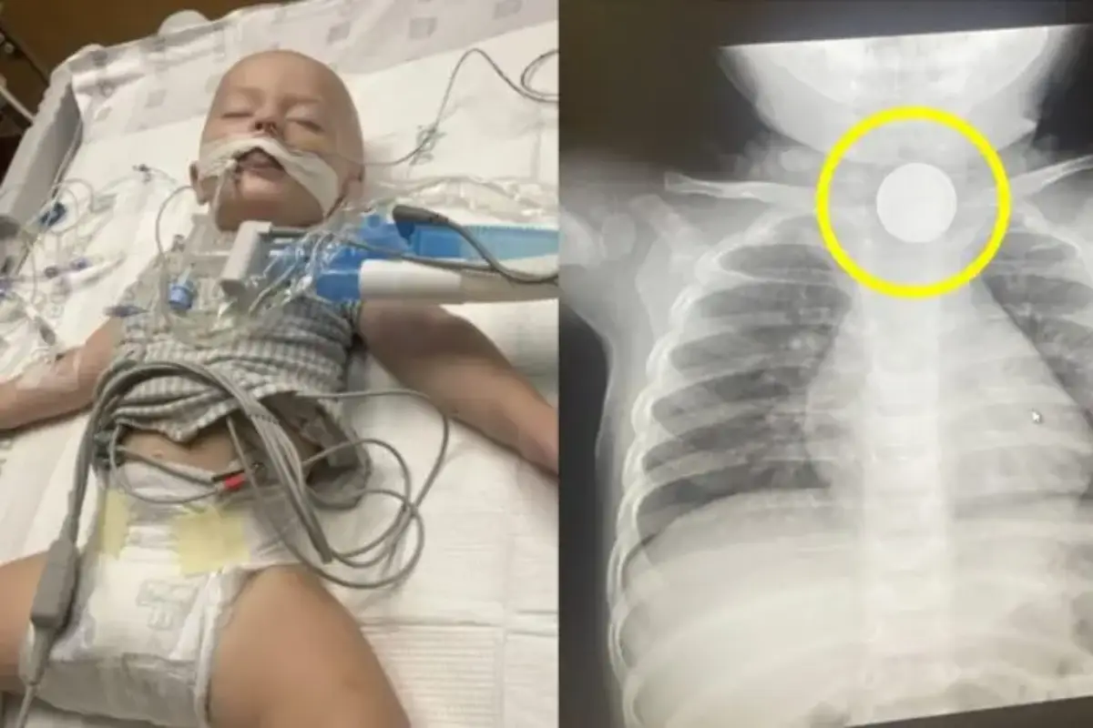 「黒い物を吐いた」…コイン電池誤飲で生死をさまよった16か月女児 母親が語る恐怖の一部始終と“教訓”とは？