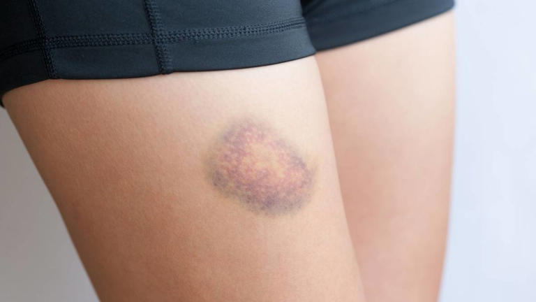 Lipedema: nove questões sobre a doença que afeta milhões de pessoas