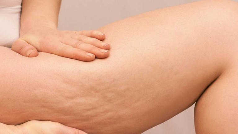 Lipedema: nove questões sobre a doença que afeta milhões de pessoas
