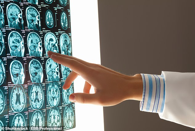 GP Calls for Immediate Action to Prevent Dementia in Your 60s