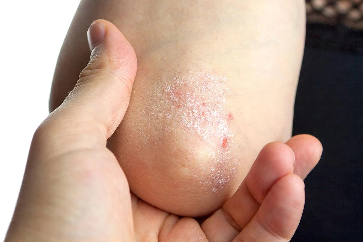 Psoriasis 101: What You Need to Know