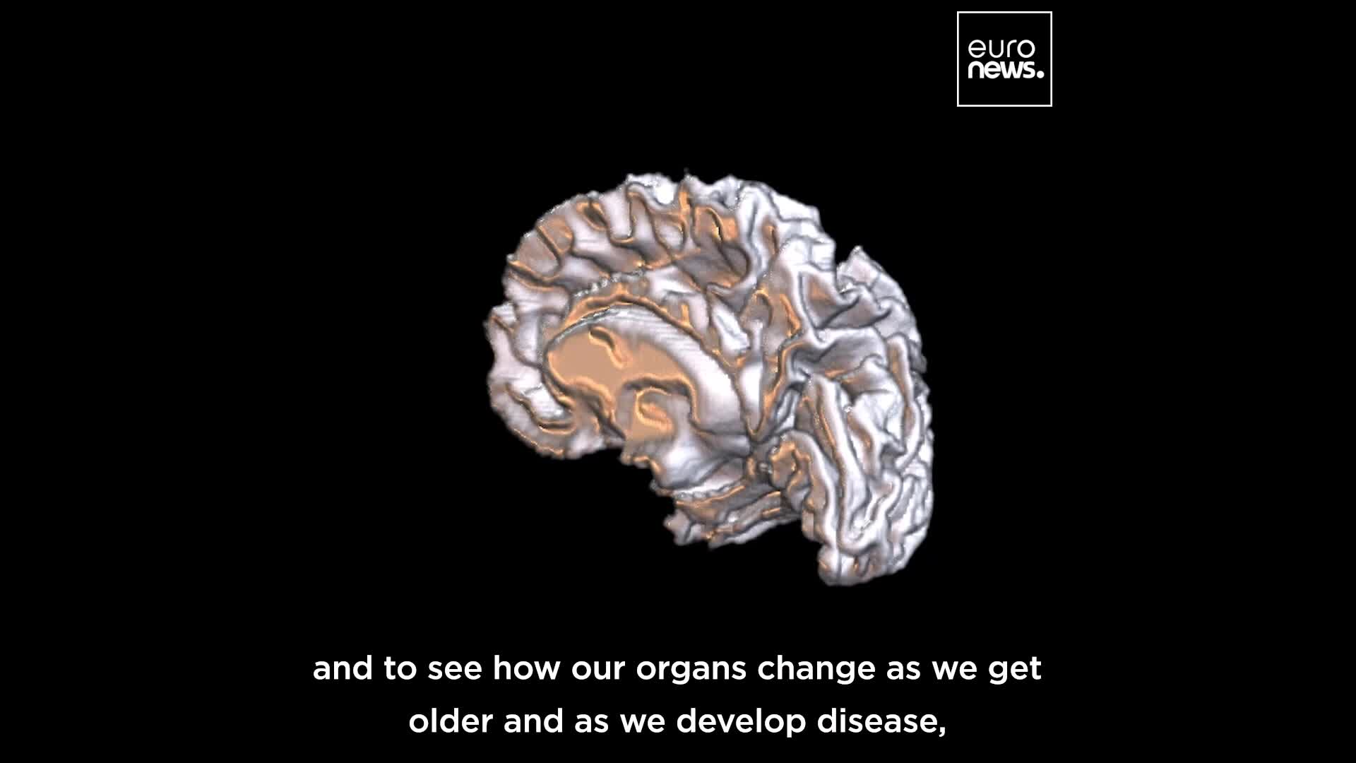 Mass health scan of 100,000 people in the UK could redefine disease