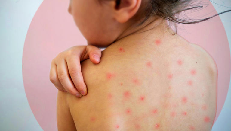 sarampion,casos de sarampión en guanajuato,Guanajuato,Secretaría de Salud en Guanajuato,Vacunas contra sarampión,Que es el sarampión,cómo detectar el sarampión.