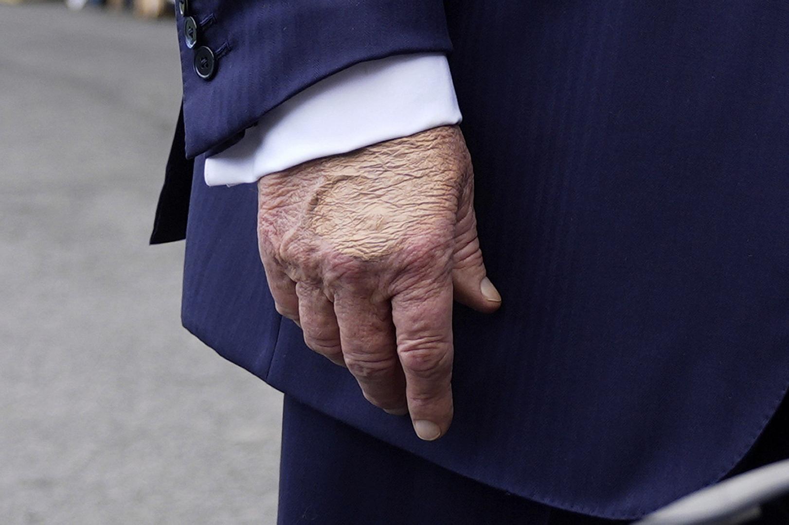 Trump diagnosed with chronic venous insufficiency after noticing ...