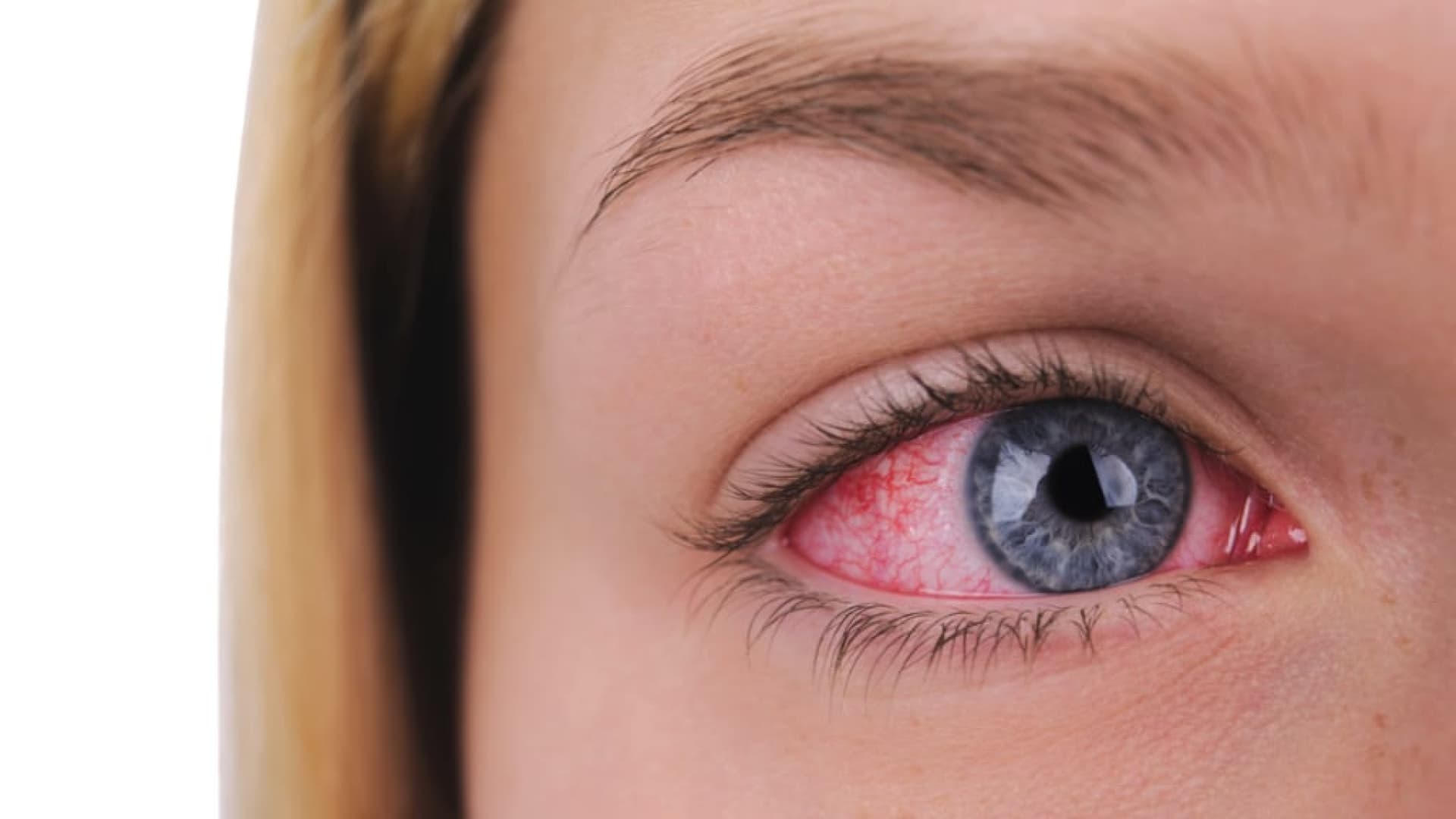 Wunderbar Rote Augen Bei Erkltung Bilder
