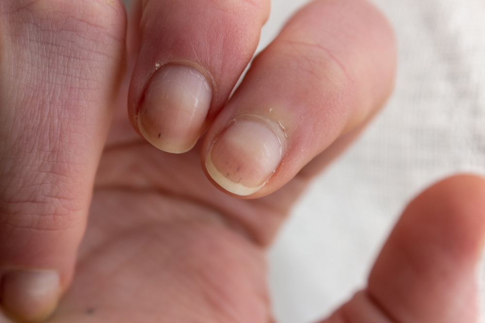 Changes in fingernails may indicate certain underlying health issues