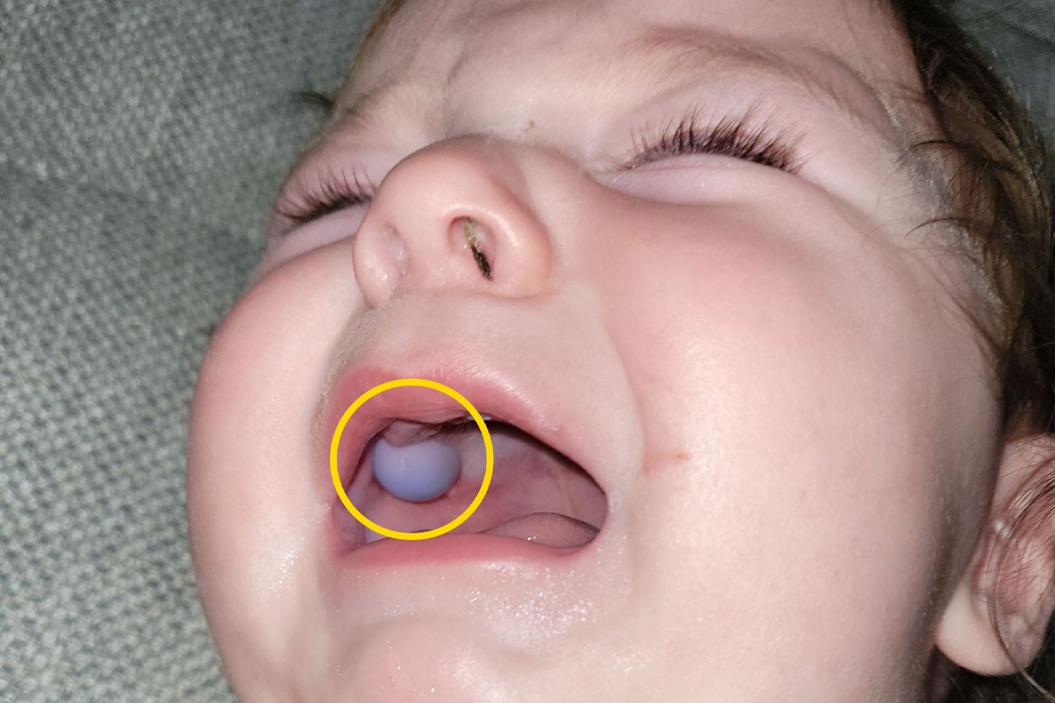 Teething 9MonthOld Has Strange Bump in His Mouth. Docs Think It's a