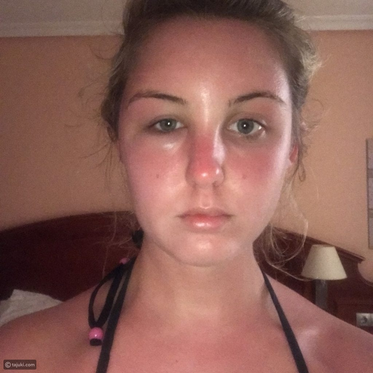 فتاة تعاني من حروق الشمس بالوجه