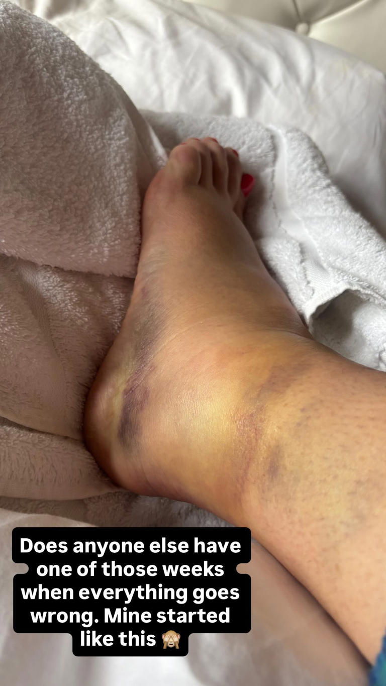 Claire shared her injury to her over 200 thousand followers on Instagram (Picture: Via Claire Sweeney’s Instagram)
