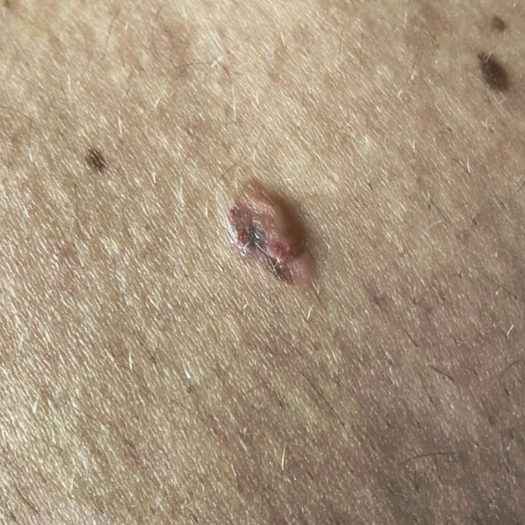Jak Howells's melanoma