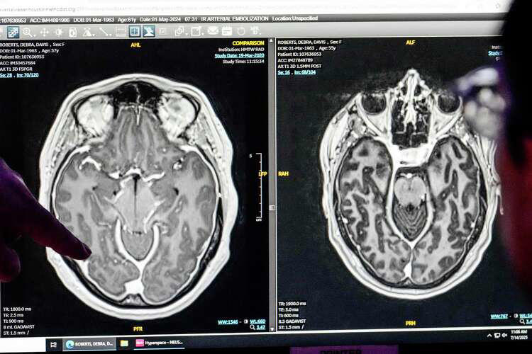 A Houston woman thought she had dementia. Then a doctor saw something