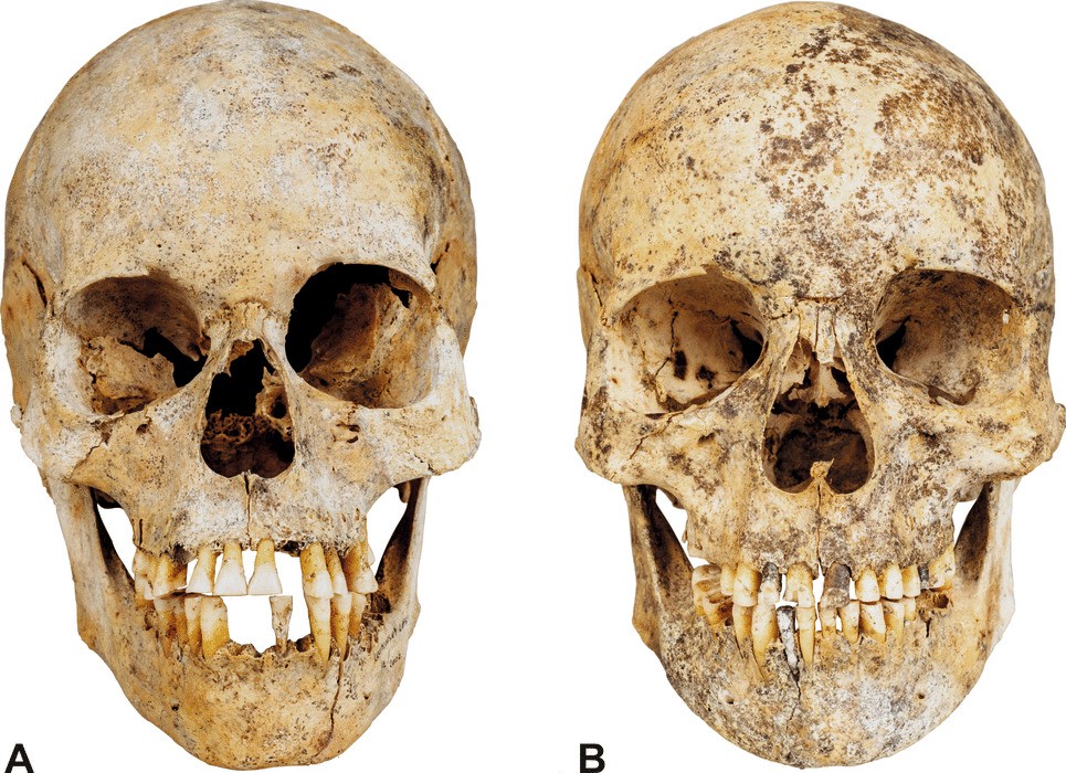 Two skulls belonging to sisters that lived 6,000 years ago.