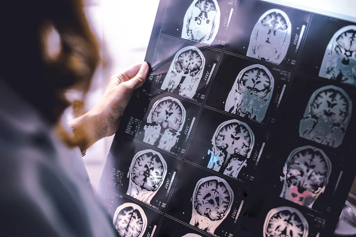 AI can detect previously invisible MS scars in the brain