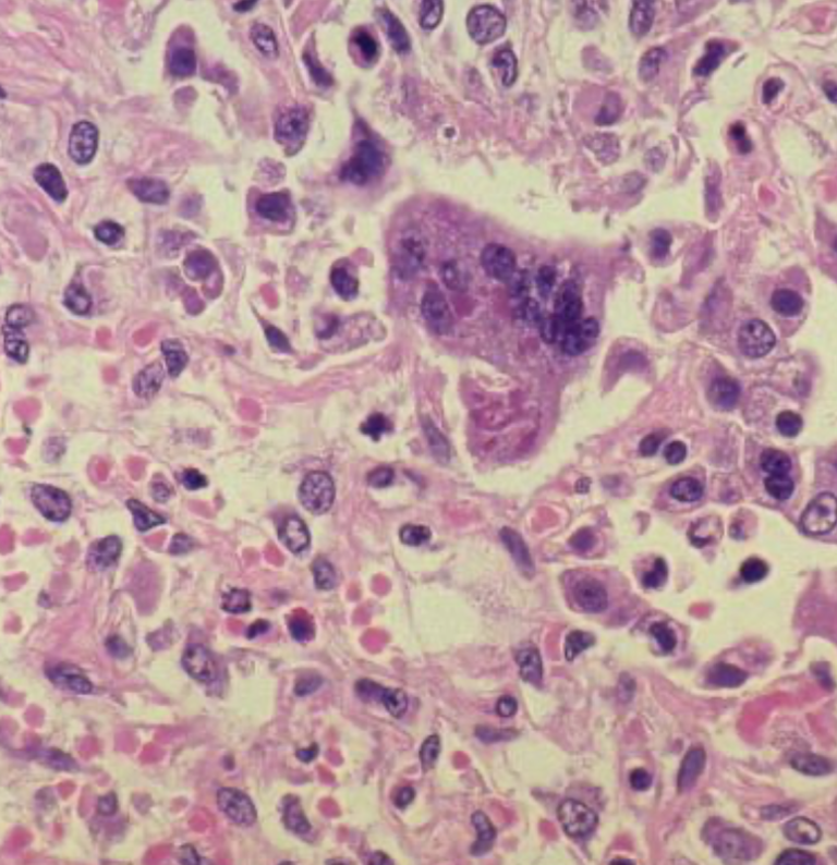 Officials urge vaccination after child contracts measles in Olmsted County