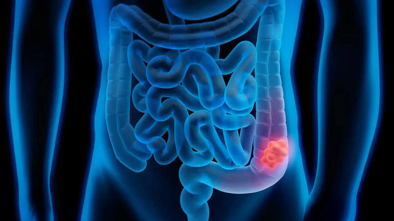 Colorectal Cancer Screenings Surge 62% After Screening Age Dropped to ...