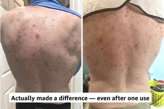 Two side-by-side images show the improvement of skin condition on a person's back after product use. Text: