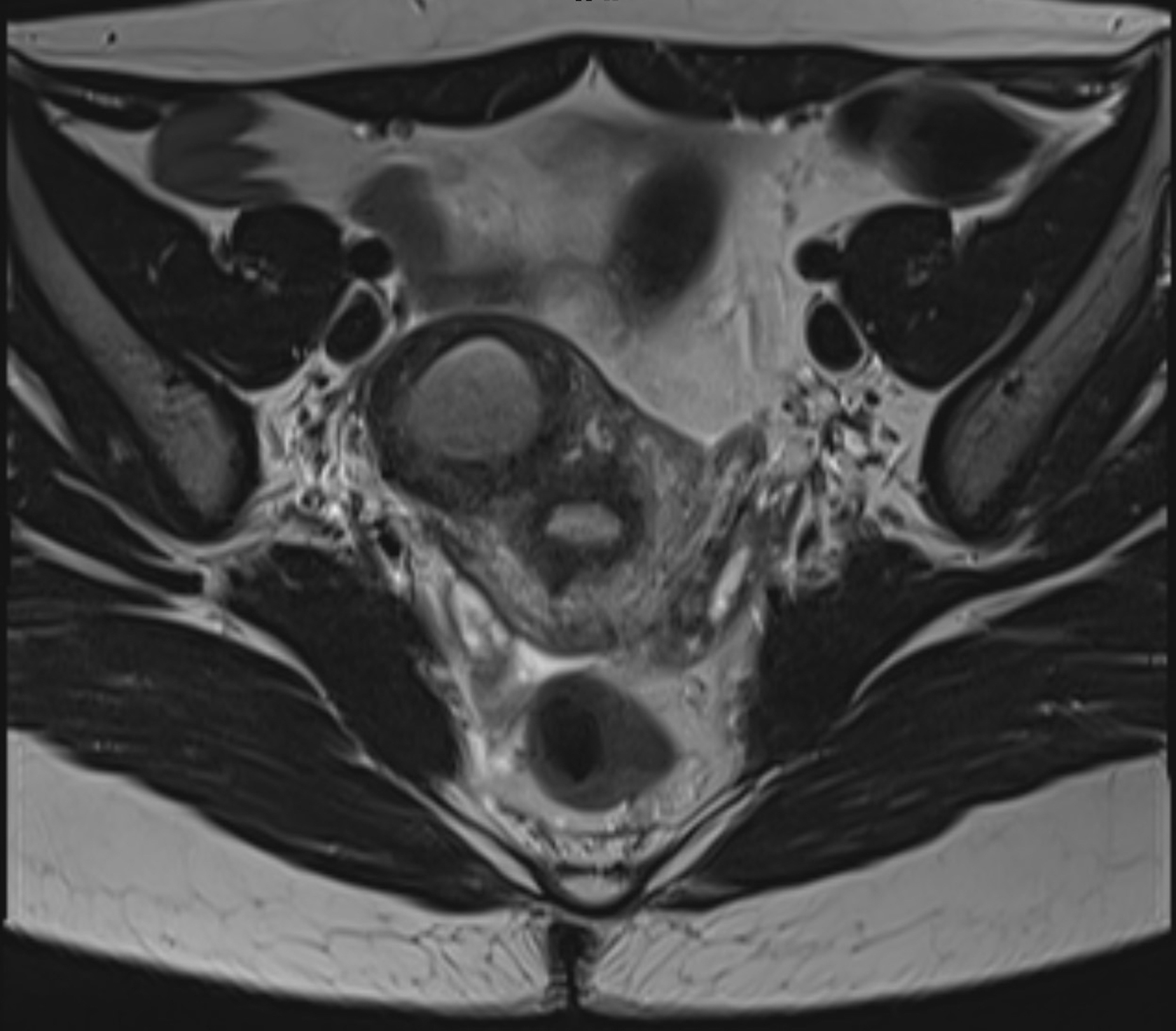 Medical scan image showing an MRI of a pelvic region, displaying internal structures for diagnostic purposes